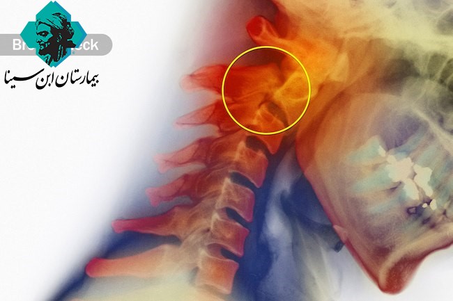 ebnesina hospital common spine problems 12