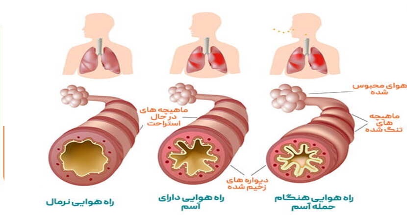 ebnesinahospital Asthma