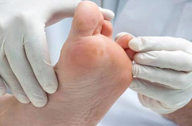 زخم پای دیابتی