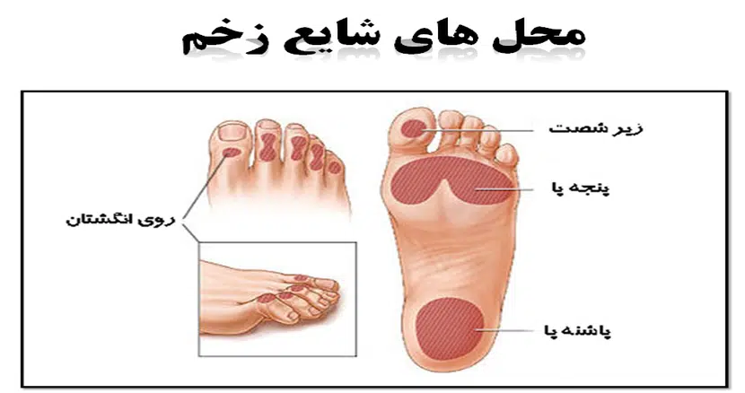 ebnesinahospital Diabetic foot1