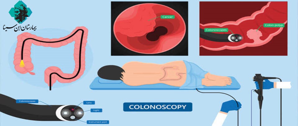 ebnesinahospital colonoscopy 1