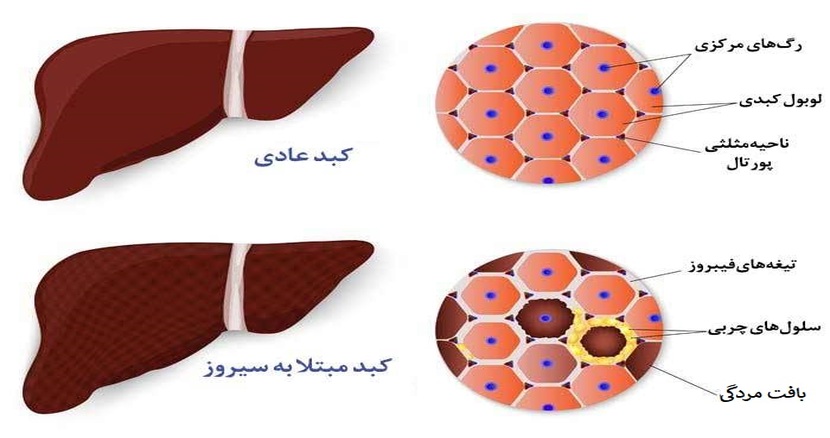 ebnesinahospital liver Cirrhosis
