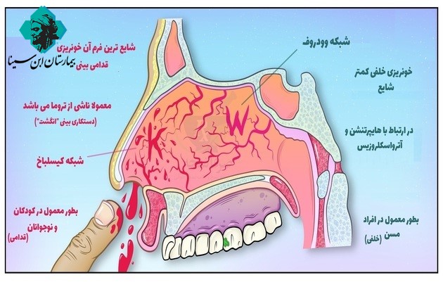 ebnesinahospital nose bleeding