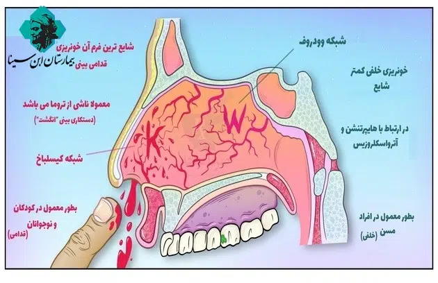ebnesinahospital nose bleeding