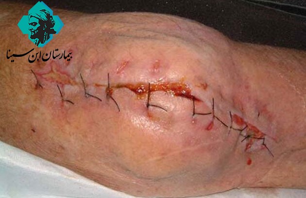 ebnesinahospital suture.2