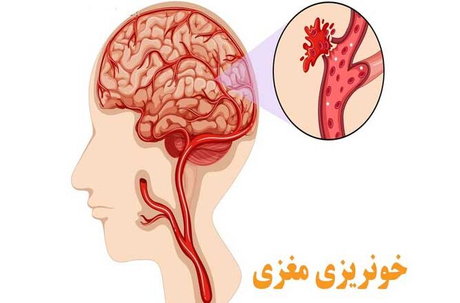 خونریزی مغزی