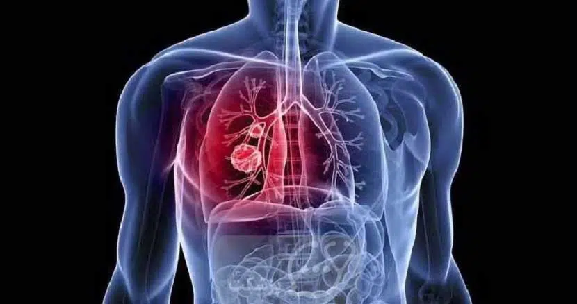 Lung cancer2