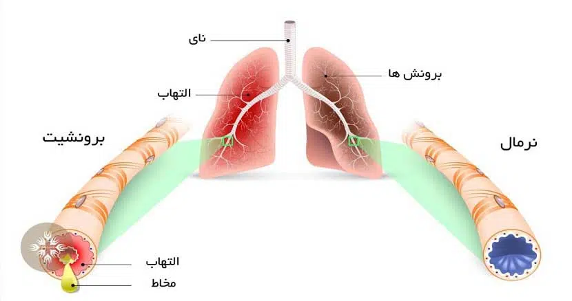 Lung cancer3