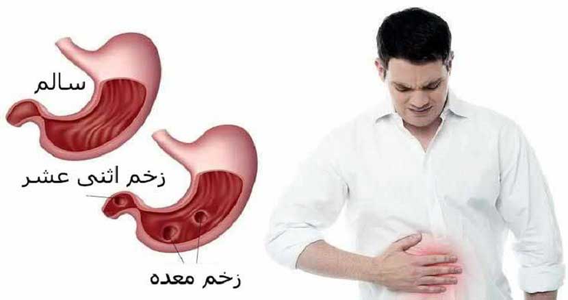 Stomach ulcer treatment2