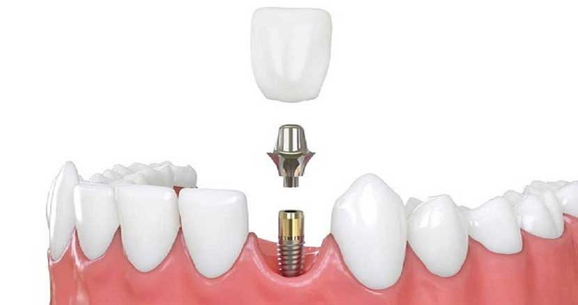 dental implant surgery 2