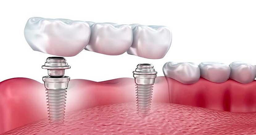 dental implant surgery 4