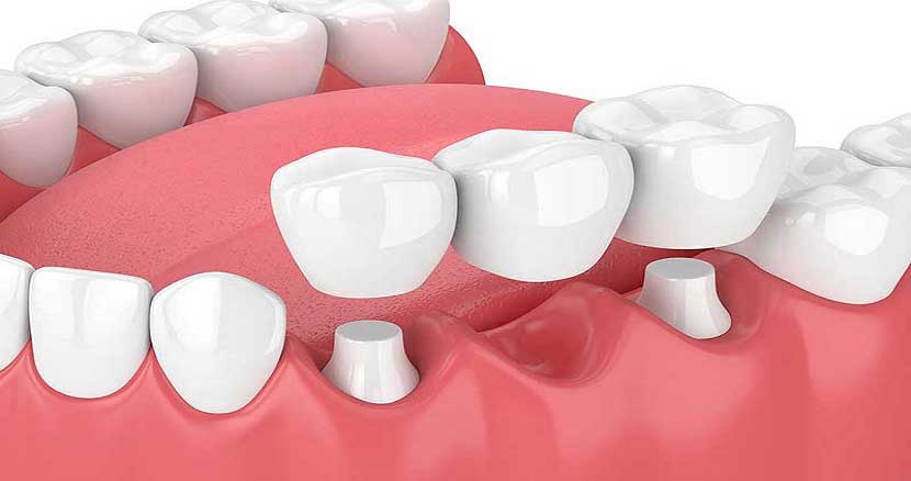 dental implant surgery 5
