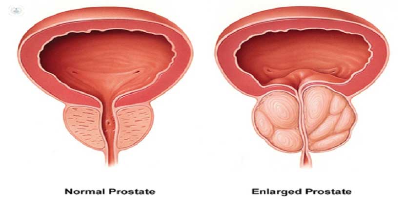 prostate cancer3