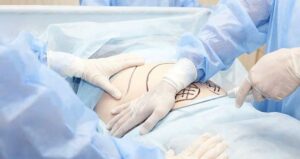 Liposuction patient pre surgery