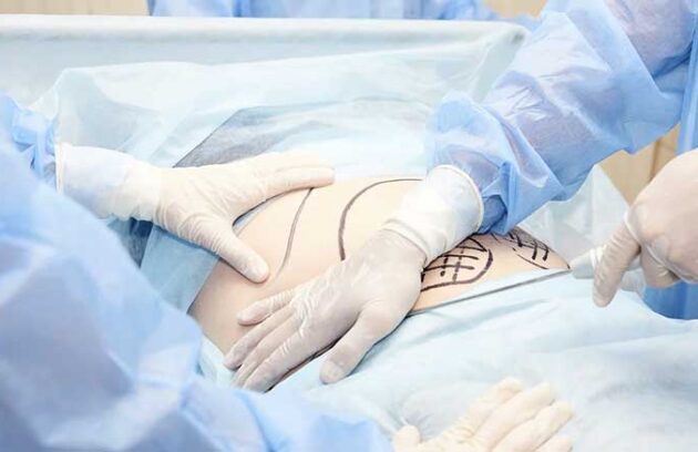 Liposuction patient pre surgery