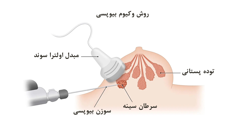 وکیوم بیوپسی